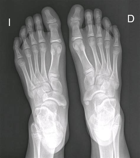 radiografia de pie